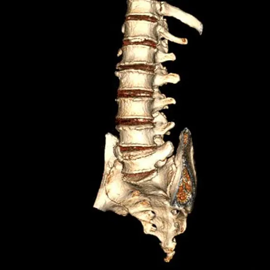 3D CT LS Spine